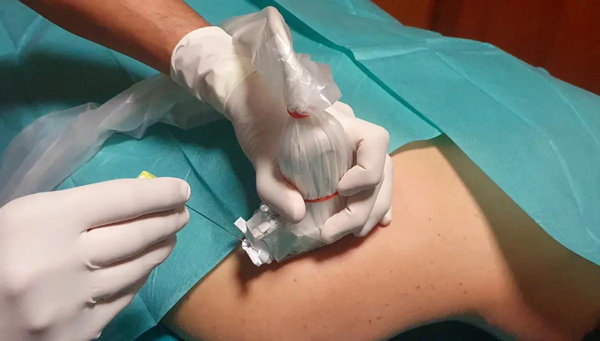 Esecuzione di un trattamento infiltrativo al ginocchio in ambiente sterile