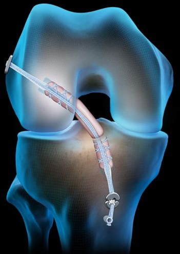 Sport medicine